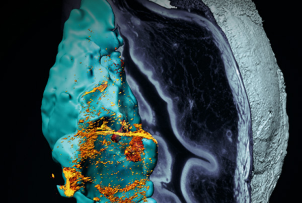 Urease-Powered Nanobots for Enhanced Radionuclide Therapy in Bladder Cancer