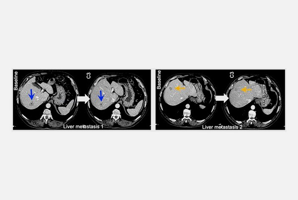 Bringing the first MYC inhibitor closer to the clinic